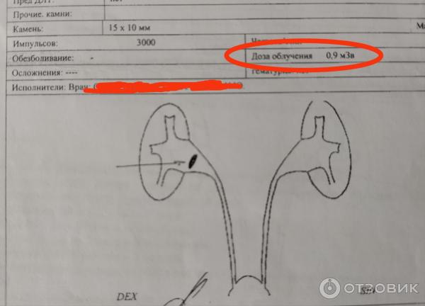 Дистанционная ударноволновая литотрипсия фото