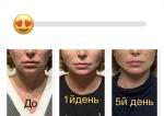 Подтяжка лица нитями Аптос фото