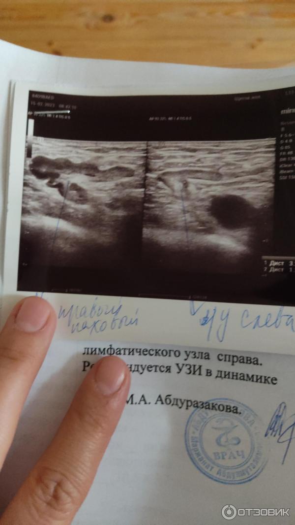 Отзыв о Свечи Нижфарм "Ихтиол" | ...нашла свое спасение!