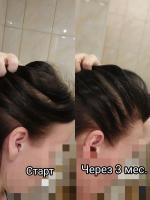 Выпадение волос у женщин: причины и как остановить, средства для лечения алопеции