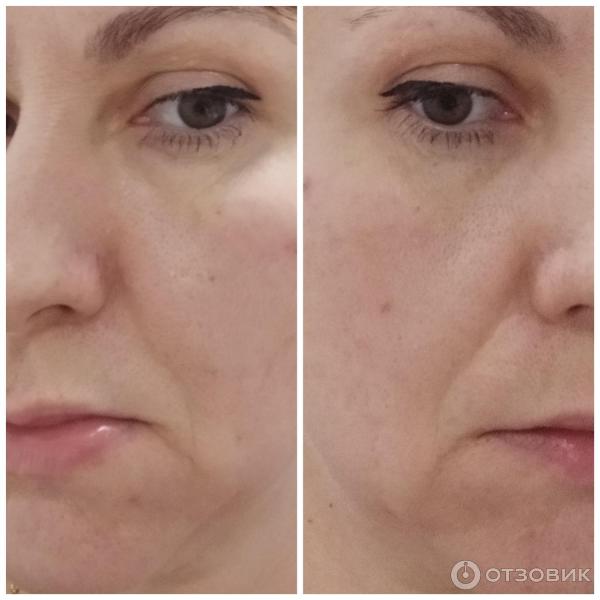 Аппарат мезотерапии RF и EMS Luxlifting Targo фото