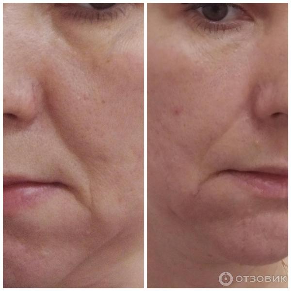 Аппарат мезотерапии RF и EMS Luxlifting Targo фото