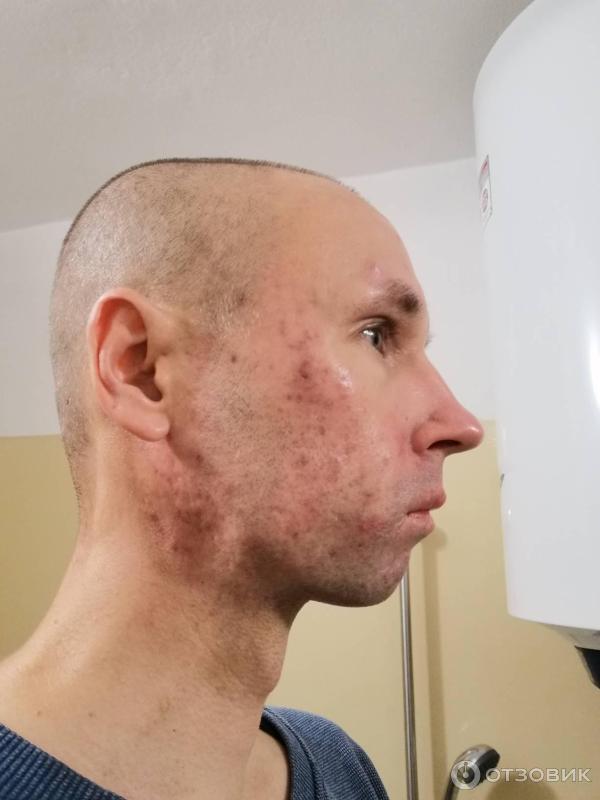 Отзыв о Косметика Libre Derm | Лучшее средство при Розацеа и Акне.